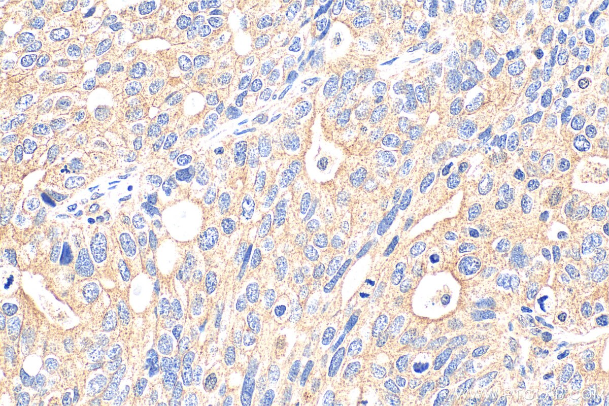 Immunohistochemistry (IHC) staining of human ovary tumor tissue using PHLDB1 Polyclonal antibody (33225-1-AP)