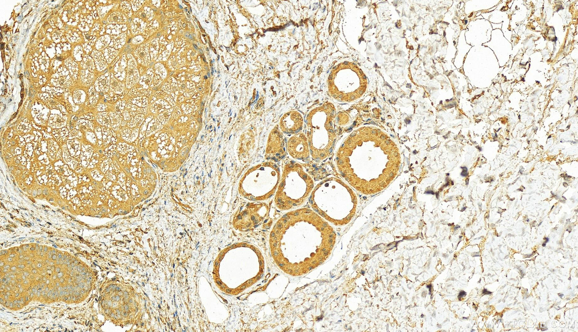 Immunohistochemistry (IHC) staining of human skin cancer tissue using PHLDB2 Polyclonal antibody (27940-1-AP)