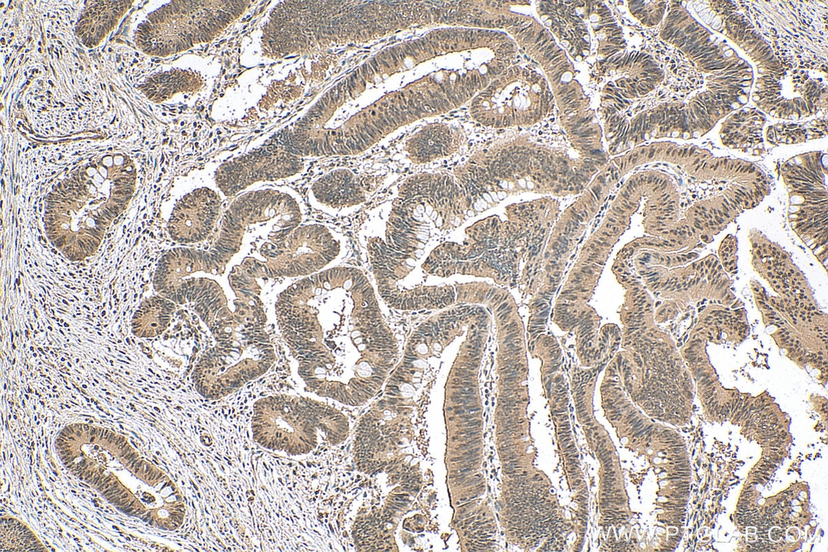 IHC staining of human colon cancer using 22789-1-AP