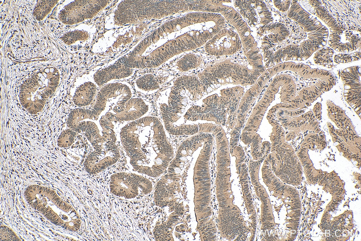 Immunohistochemistry (IHC) staining of human colon cancer tissue using PHLPP Polyclonal antibody (22789-1-AP)