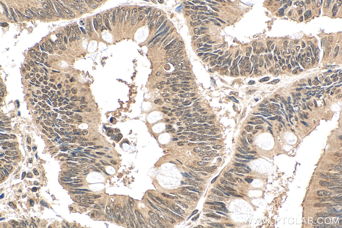 Immunohistochemistry (IHC) staining of human colon cancer tissue using PHLPP Polyclonal antibody (22789-1-AP)