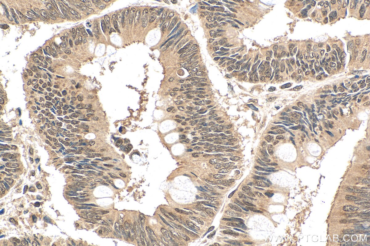 IHC staining of human colon cancer using 22789-1-AP