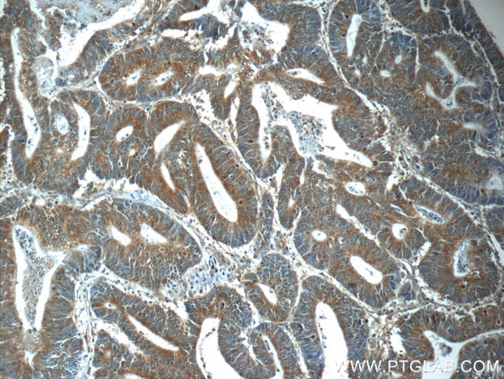 Immunohistochemistry (IHC) staining of human colon cancer tissue using PHLPPL Polyclonal antibody (25244-1-AP)