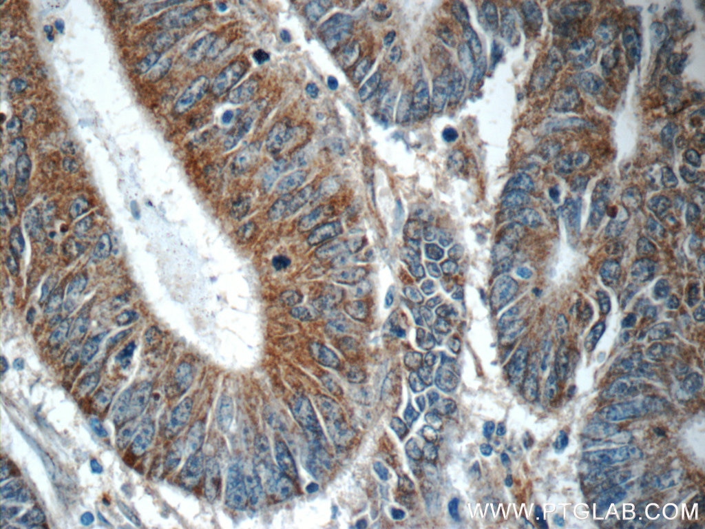 Immunohistochemistry (IHC) staining of human colon cancer tissue using PHLPPL Polyclonal antibody (25244-1-AP)