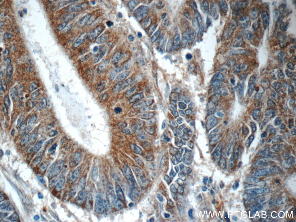 Immunohistochemistry (IHC) staining of human colon cancer tissue using PHLPPL Polyclonal antibody (25244-1-AP)