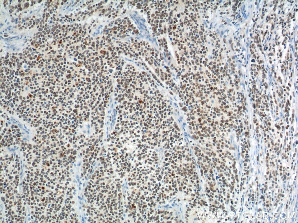 Immunohistochemistry (IHC) staining of neuroblastoma tissue using PHOX2B Polyclonal antibody (25276-1-AP)