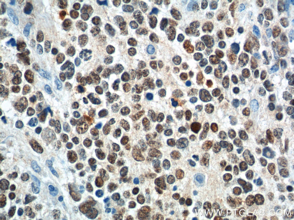 Immunohistochemistry (IHC) staining of neuroblastoma tissue using PHOX2B Polyclonal antibody (25276-1-AP)