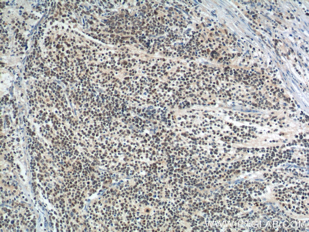 Immunohistochemistry (IHC) staining of neuroblastoma tissue using PHOX2B Monoclonal antibody (66254-1-Ig)