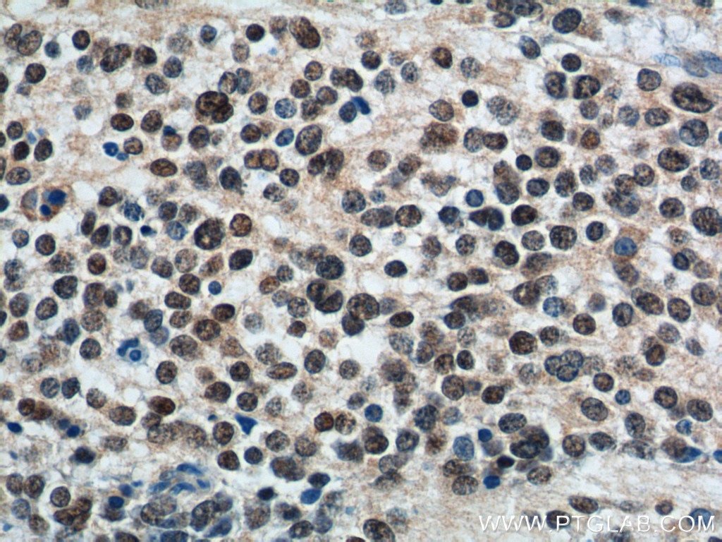 Immunohistochemistry (IHC) staining of neuroblastoma tissue using PHOX2B Monoclonal antibody (66254-1-Ig)