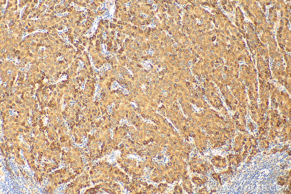 Immunohistochemistry (IHC) staining of human liver cancer tissue using PI16 Polyclonal antibody (12267-1-AP)