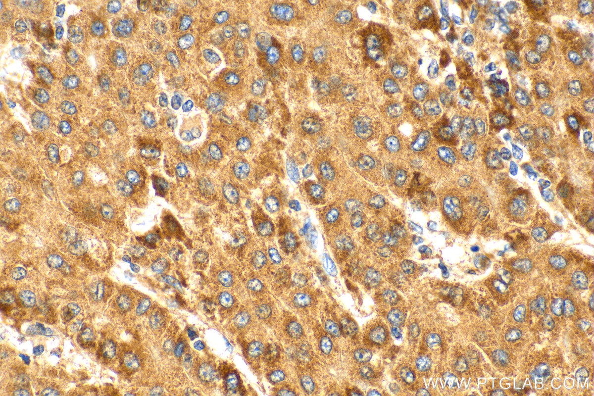 Immunohistochemistry (IHC) staining of human liver cancer tissue using PI16 Polyclonal antibody (12267-1-AP)