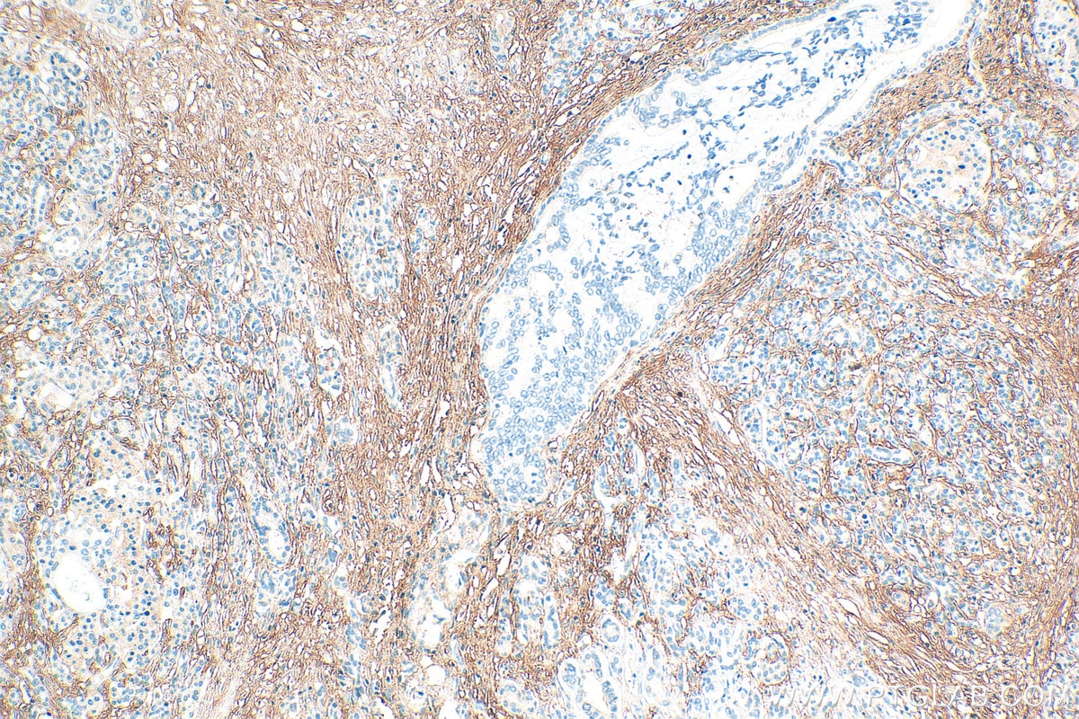 Immunohistochemistry (IHC) staining of human pancreas cancer tissue using PI16 Polyclonal antibody (12267-1-AP)