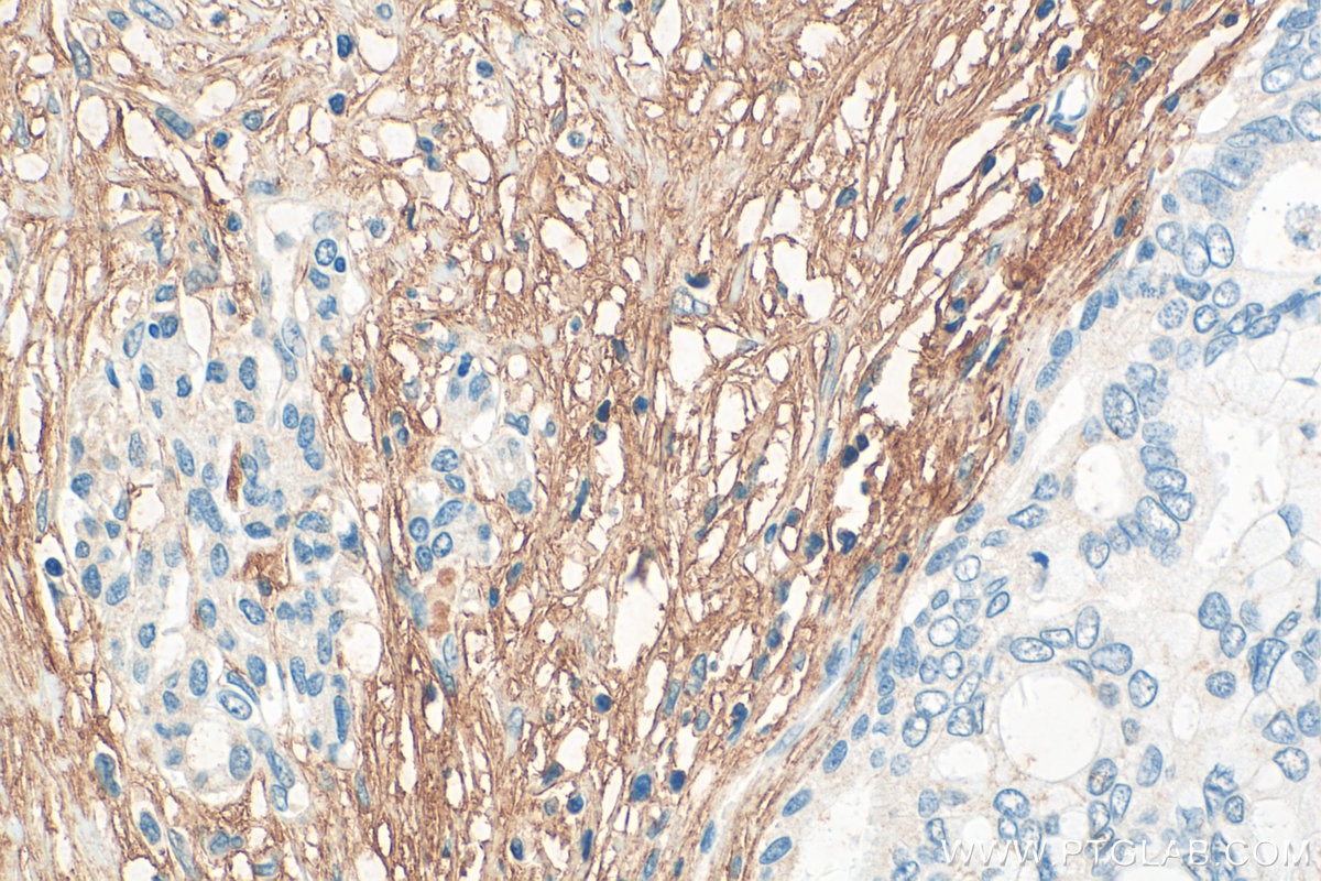 Immunohistochemistry (IHC) staining of human pancreas cancer tissue using PI16 Polyclonal antibody (12267-1-AP)