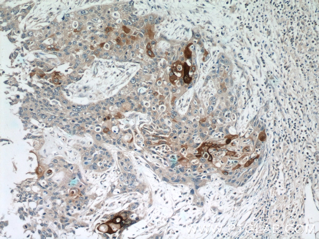 Immunohistochemistry (IHC) staining of human oesophagus cancer tissue using Elafin/Skalp Polyclonal antibody (15963-1-AP)