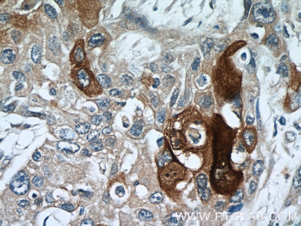 Immunohistochemistry (IHC) staining of human oesophagus cancer tissue using Elafin/Skalp Polyclonal antibody (15963-1-AP)