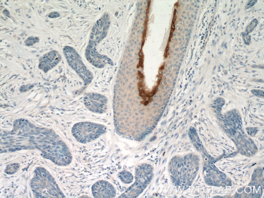 Immunohistochemistry (IHC) staining of human skin cancer tissue using Elafin/Skalp Polyclonal antibody (15963-1-AP)