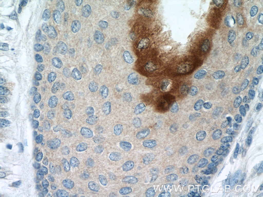 Immunohistochemistry (IHC) staining of human skin cancer tissue using Elafin/Skalp Polyclonal antibody (15963-1-AP)