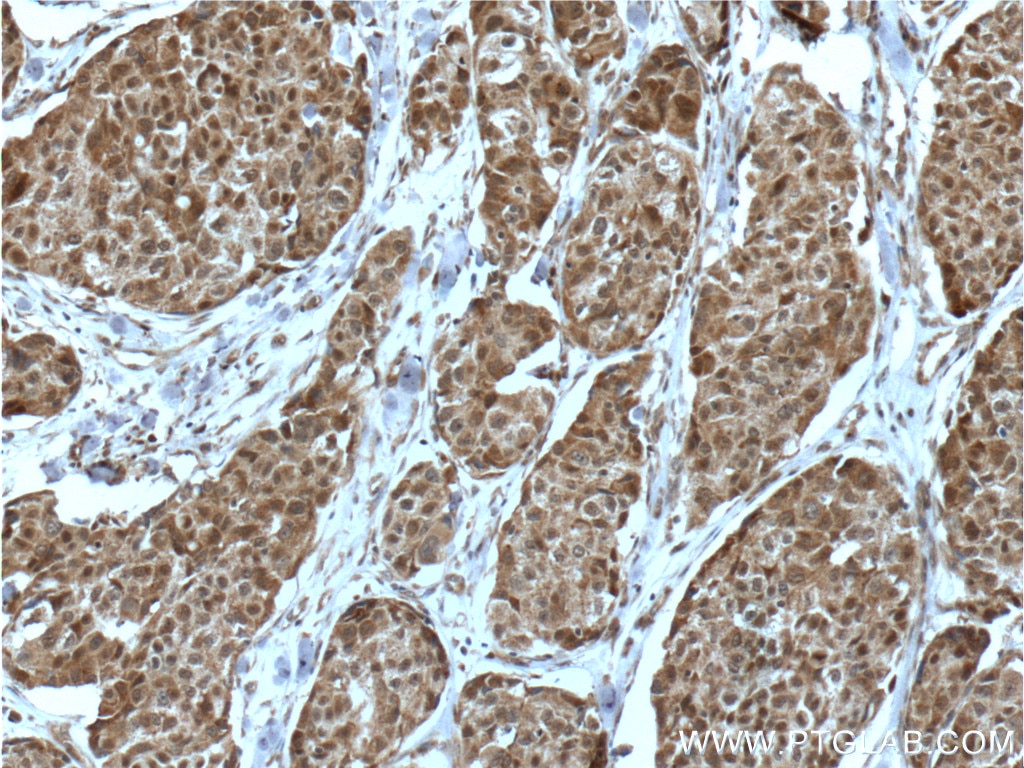 IHC staining of human lung cancer using 13486-1-AP