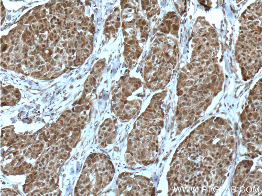 Immunohistochemistry (IHC) staining of human lung cancer tissue using PIAS3 Polyclonal antibody (13486-1-AP)