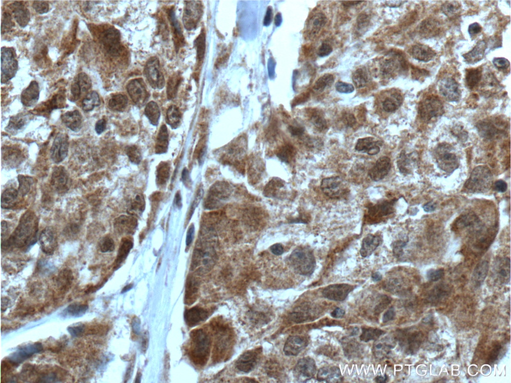 Immunohistochemistry (IHC) staining of human lung cancer tissue using PIAS3 Polyclonal antibody (13486-1-AP)