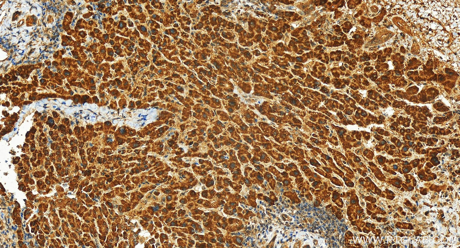 Immunohistochemistry (IHC) staining of human intrahepatic cholangiocarcinoma tissue using PIBF1 Polyclonal antibody (14413-1-AP)