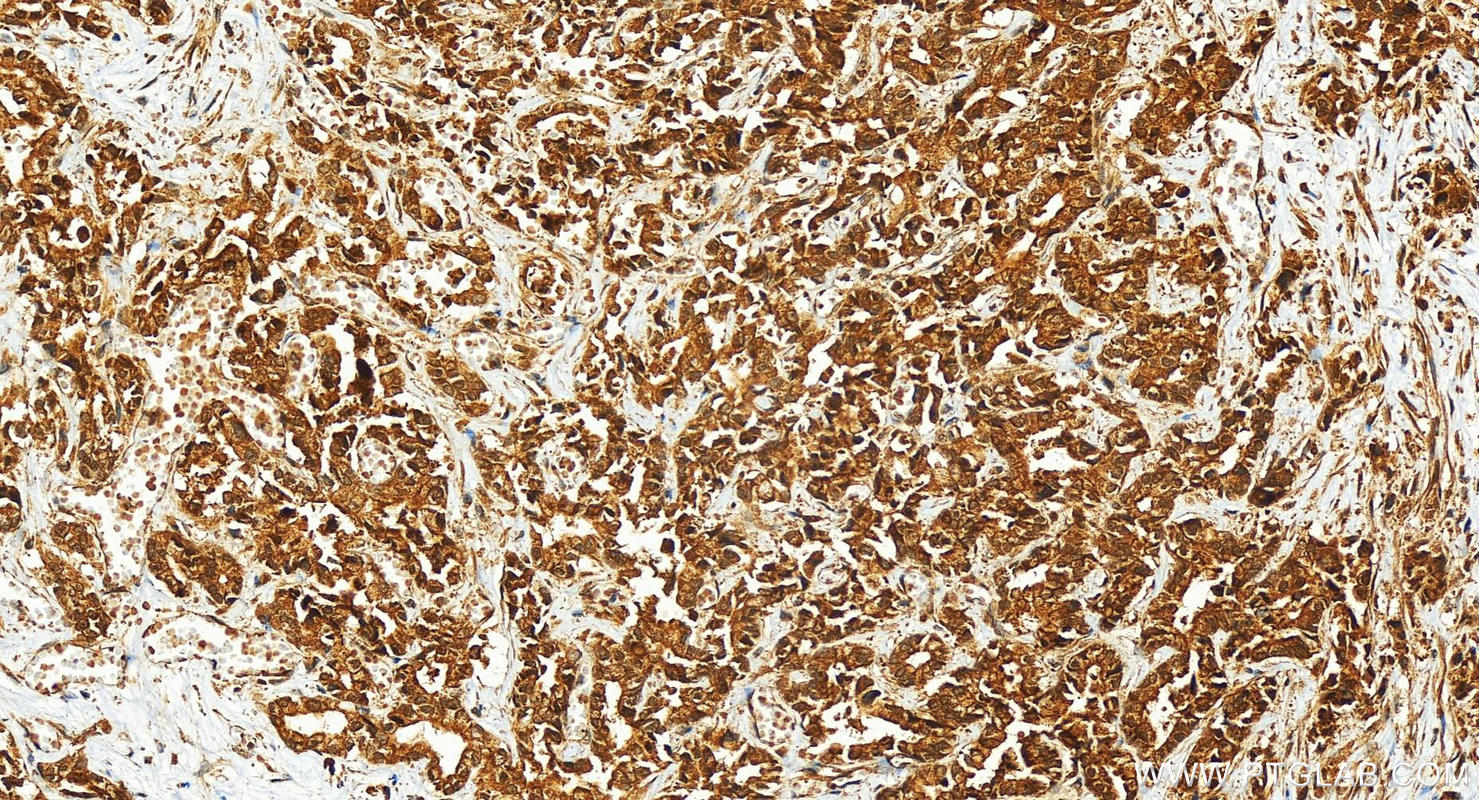 Immunohistochemistry (IHC) staining of human intrahepatic cholangiocarcinoma tissue using PIBF1 Polyclonal antibody (14413-1-AP)