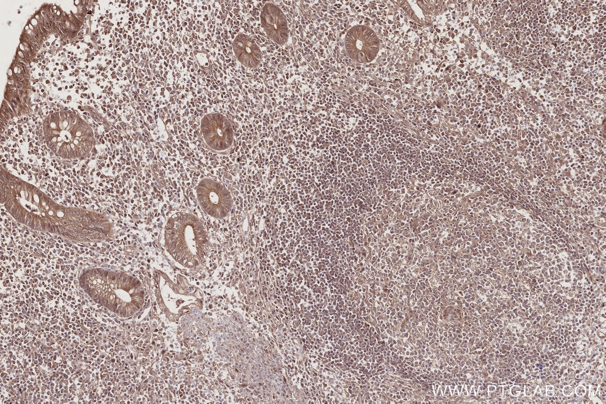 IHC staining of human appendicitis using 14413-1-AP Immunohistochemistry (IHC) staining of human appendicitis tissue using PIBF1 Polyclonal antibody (14413-1-AP)