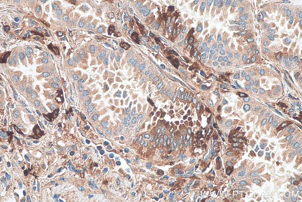 Immunohistochemistry (IHC) staining of human lung cancer tissue using PICALM Monoclonal antibody (67564-1-Ig)