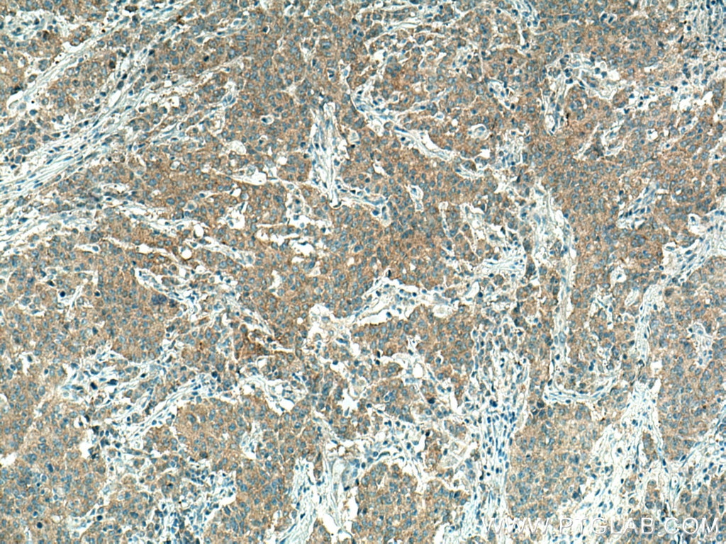 Immunohistochemistry (IHC) staining of human stomach cancer tissue using PICK1 Polyclonal antibody (10983-2-AP)