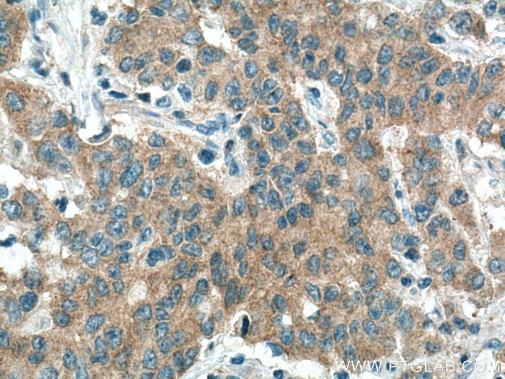 Immunohistochemistry (IHC) staining of human stomach cancer tissue using PICK1 Polyclonal antibody (10983-2-AP)