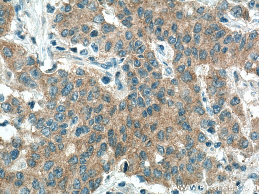 IHC staining of human stomach cancer using 10983-2-AP