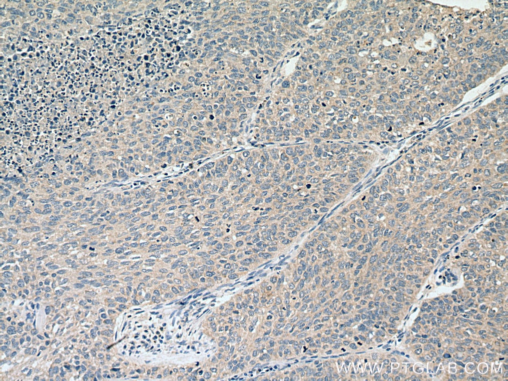 Immunohistochemistry (IHC) staining of human lung cancer tissue using Piezo1 (extracellular domain) Polyclonal antibody (28511-1-AP)