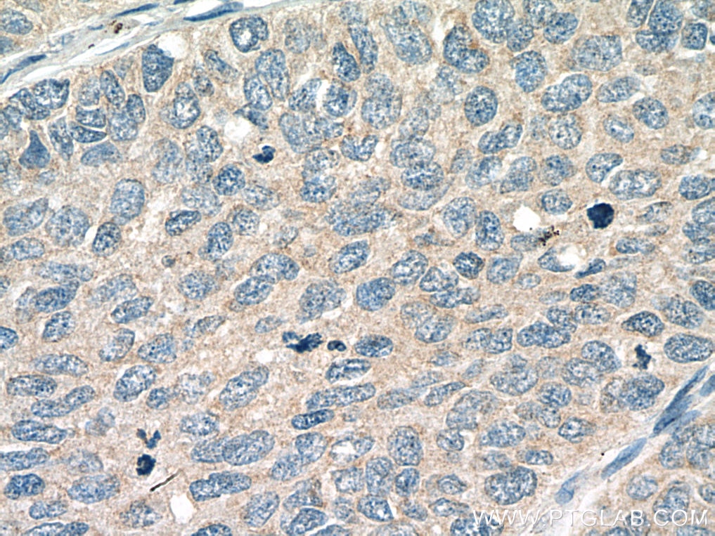 Immunohistochemistry (IHC) staining of human lung cancer tissue using Piezo1 (extracellular domain) Polyclonal antibody (28511-1-AP)