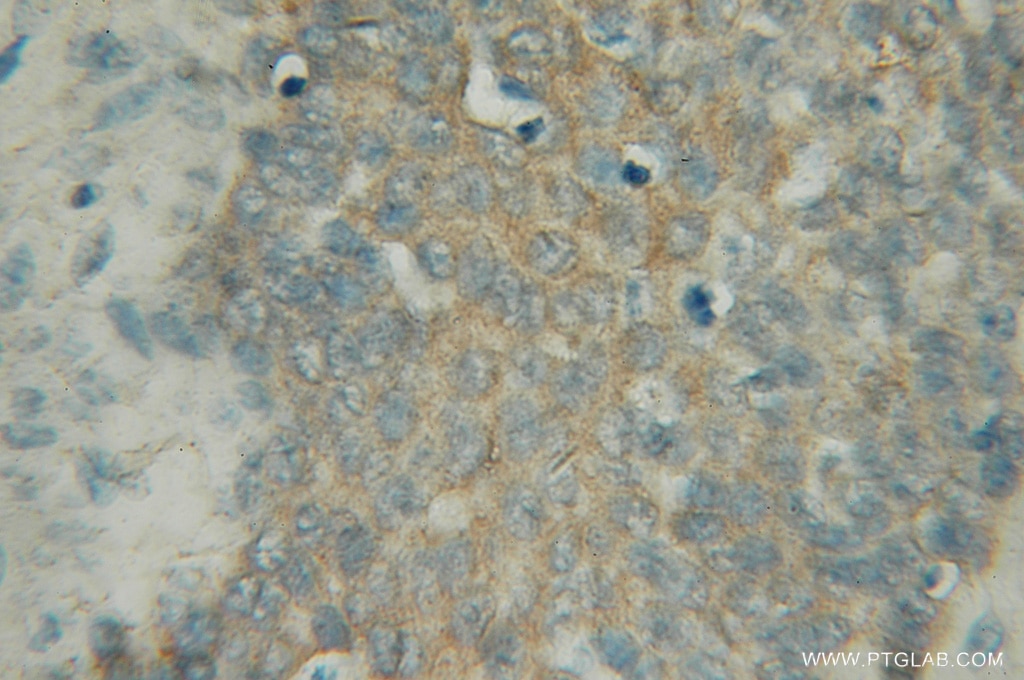 Immunohistochemistry (IHC) staining of human prostate cancer tissue using PIGB Polyclonal antibody (12612-1-AP)