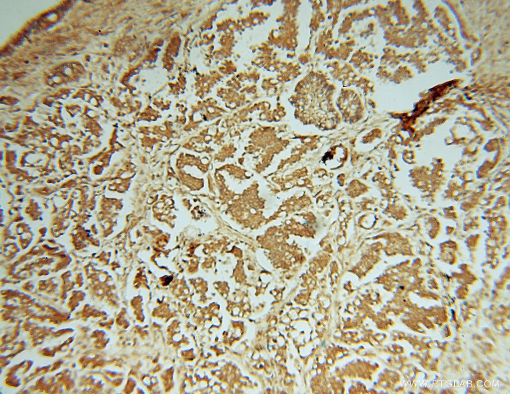 Immunohistochemistry (IHC) staining of human ovary tumor tissue using PIGK Polyclonal antibody (15151-1-AP)
