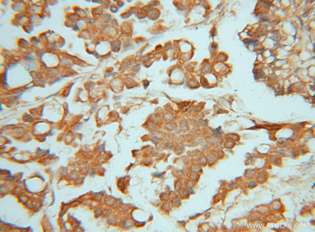 Immunohistochemistry (IHC) staining of human ovary tumor tissue using PIGK Polyclonal antibody (15151-1-AP)