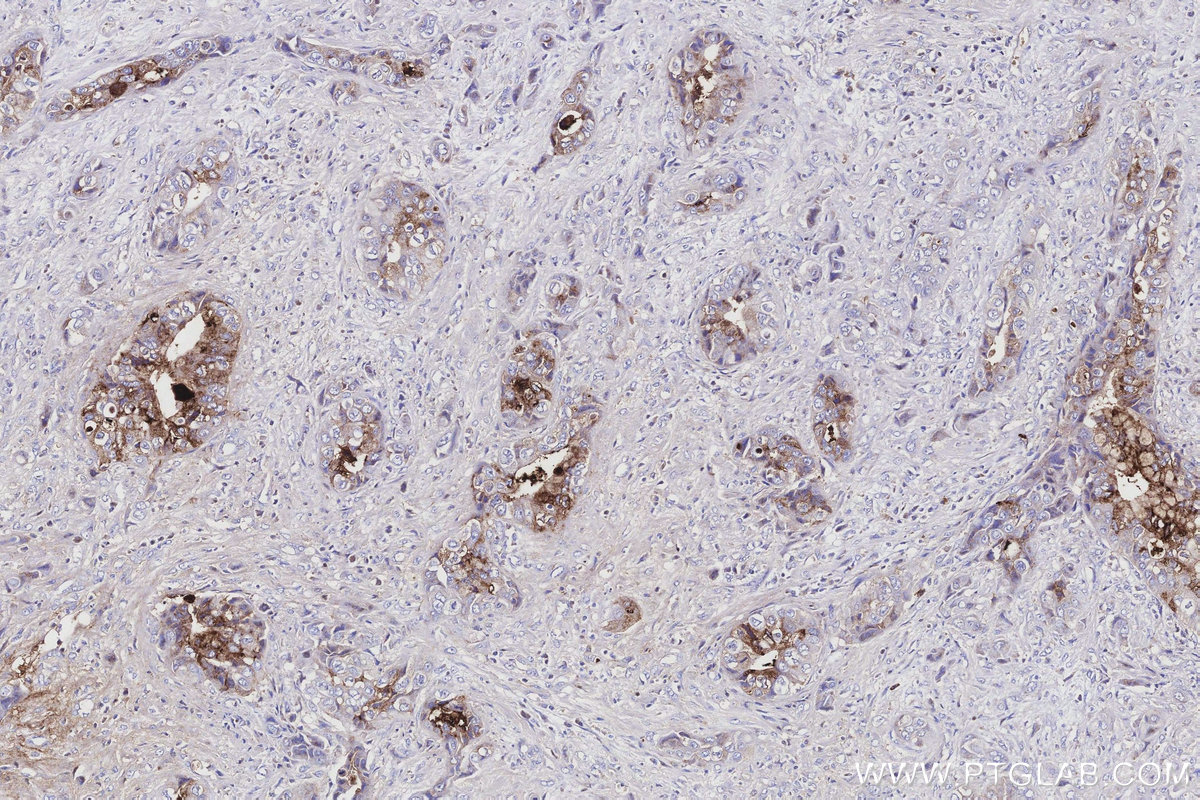 IHC staining of human pancreas cancer using 22024-1-AP Immunohistochemistry (IHC) staining of human pancreas cancer tissue using PIGR Polyclonal antibody (22024-1-AP)