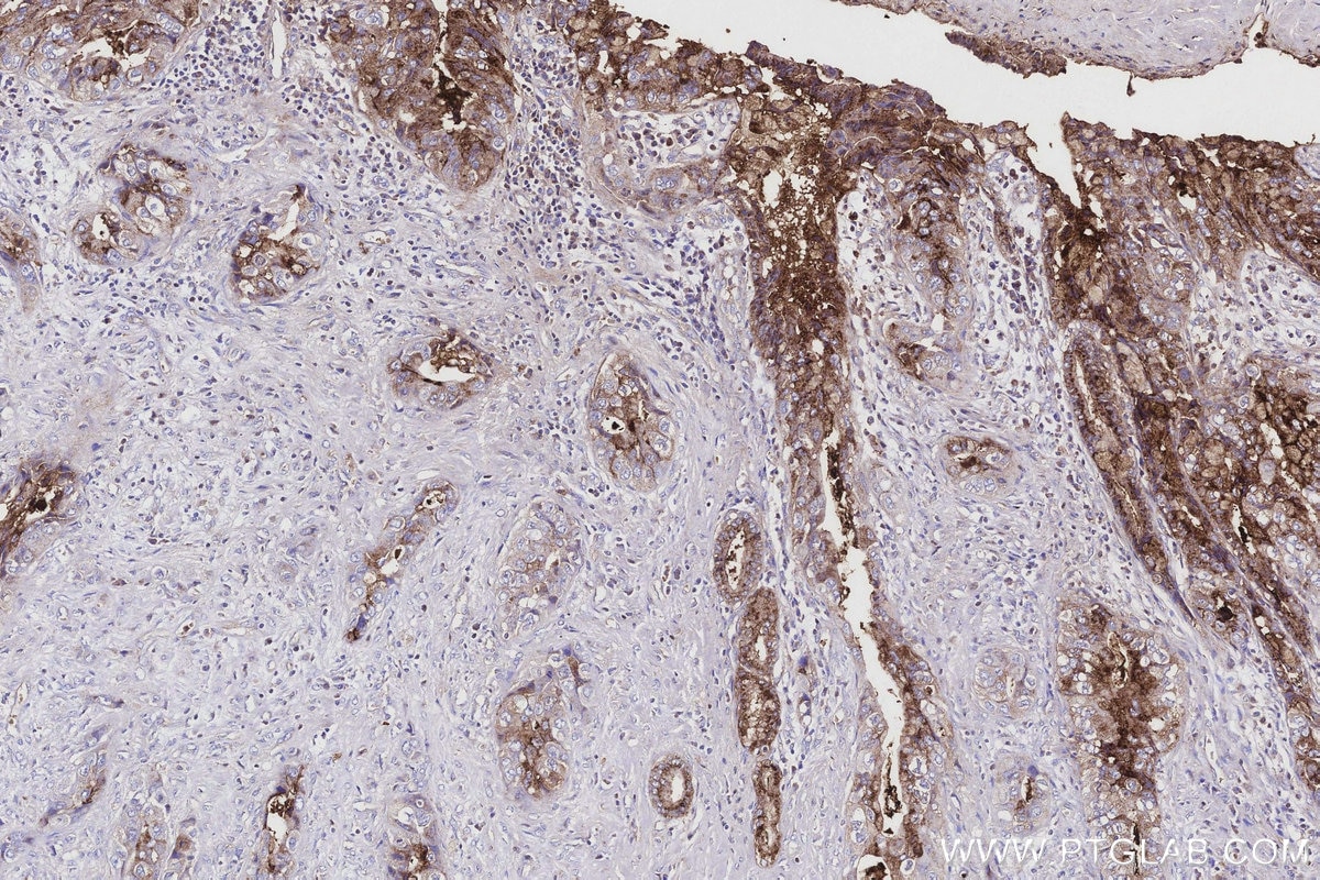 IHC staining of human pancreas cancer using 22024-1-AP Immunohistochemistry (IHC) staining of human pancreas cancer tissue using PIGR Polyclonal antibody (22024-1-AP)