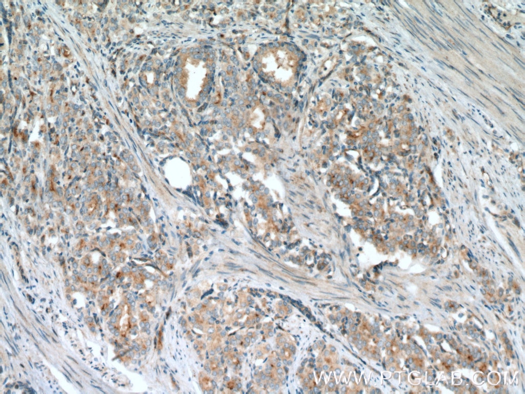 Immunohistochemistry (IHC) staining of human prostate cancer tissue using VPS34 (C terminal) Polyclonal antibody (12452-1-AP)