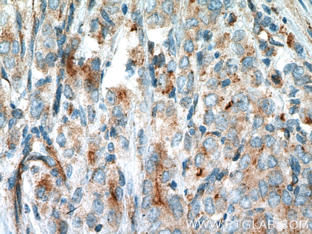 Immunohistochemistry (IHC) staining of human prostate cancer tissue using VPS34 (C terminal) Polyclonal antibody (12452-1-AP)