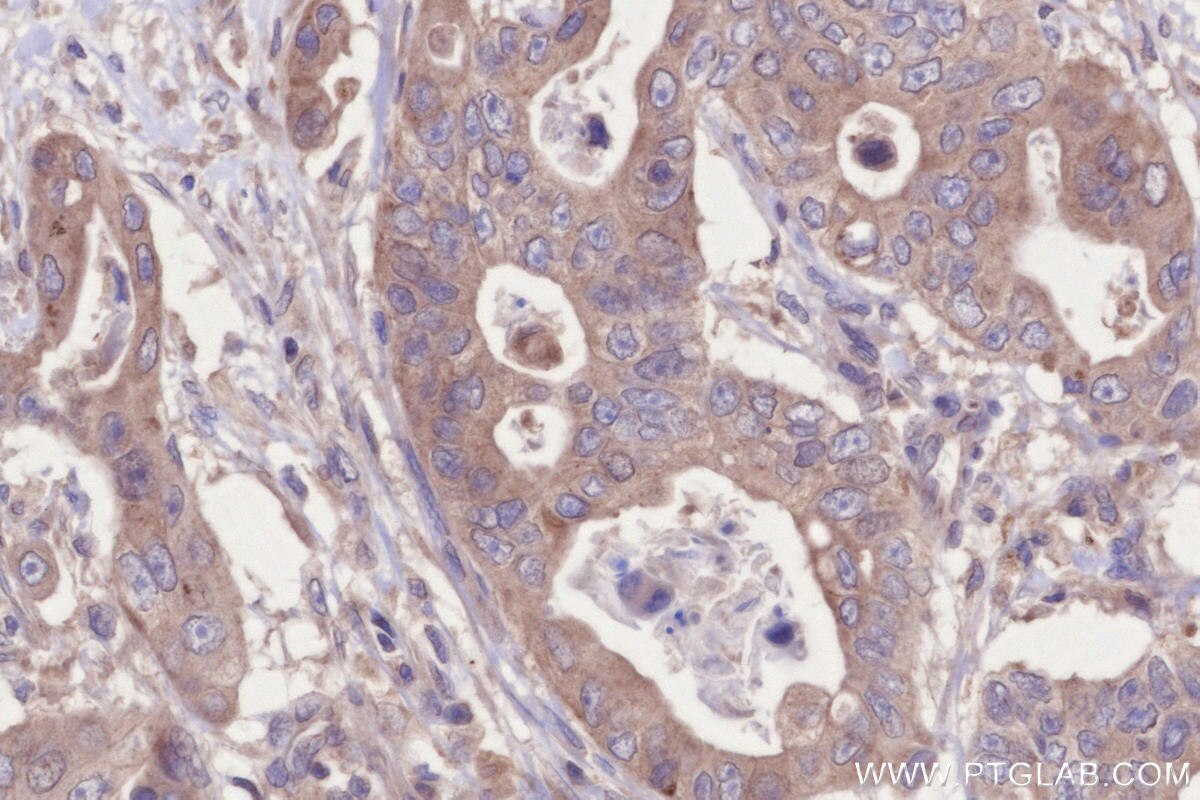Immunohistochemistry (IHC) staining of human stomach cancer tissue using VPS34 Polyclonal antibody (13723-1-AP)