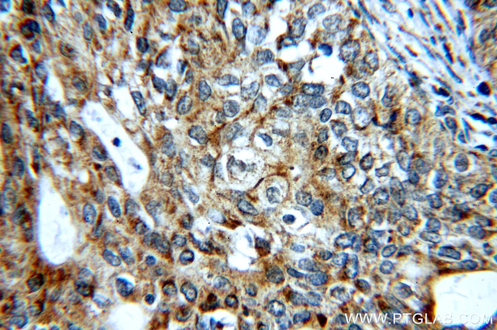 Immunohistochemistry (IHC) staining of human cervical cancer tissue using PI3 Kinase p110 Alpha Polyclonal antibody (20583-1-AP)