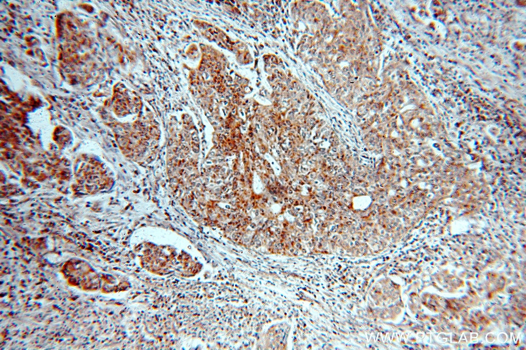 Immunohistochemistry (IHC) staining of human cervical cancer tissue using PI3 Kinase p110 Alpha Polyclonal antibody (20583-1-AP)