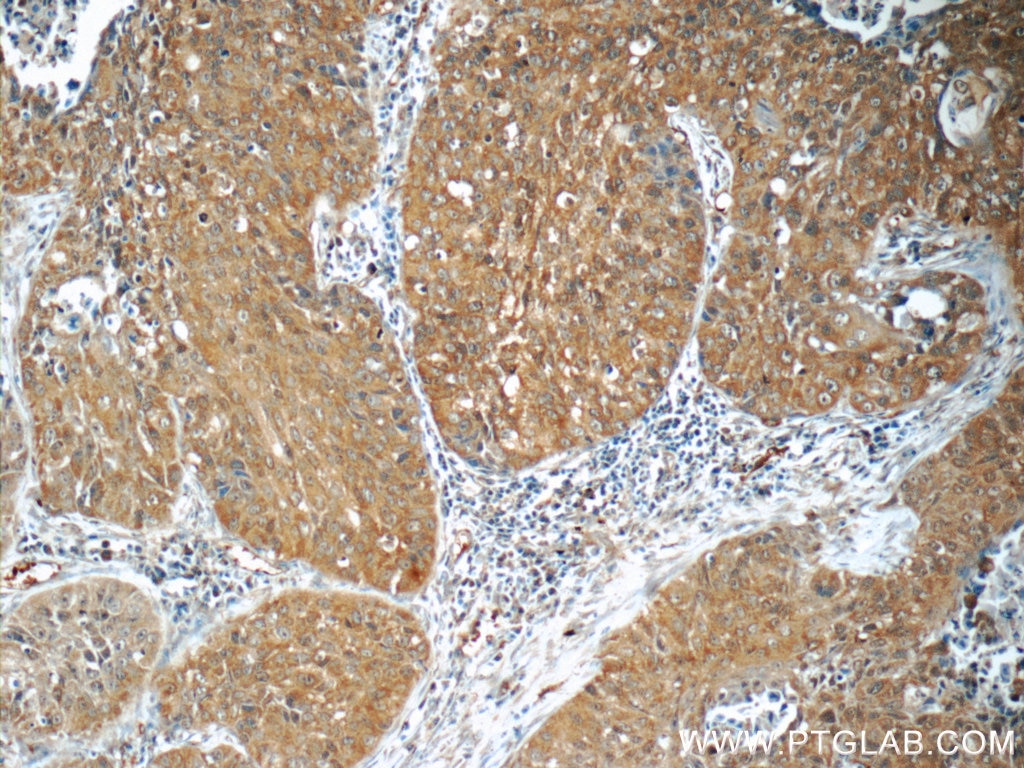 Immunohistochemistry (IHC) staining of human lung cancer tissue using PI3 Kinase p110 Alpha Polyclonal antibody (21890-1-AP)