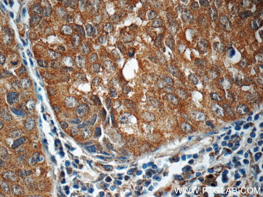 Immunohistochemistry (IHC) staining of human lung cancer tissue using PI3 Kinase p110 Alpha Polyclonal antibody (21890-1-AP)