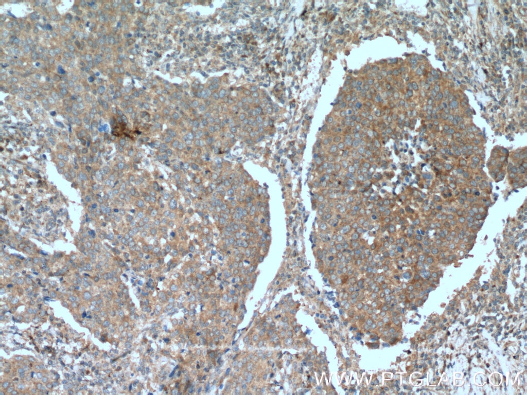 Immunohistochemistry (IHC) staining of human lung cancer tissue using PI3 Kinase p110 Alpha Polyclonal antibody (21890-1-AP)