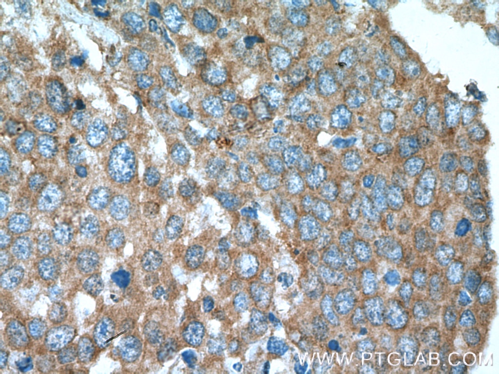 Immunohistochemistry (IHC) staining of human lung cancer tissue using PI3 Kinase p110 Alpha Polyclonal antibody (21890-1-AP)