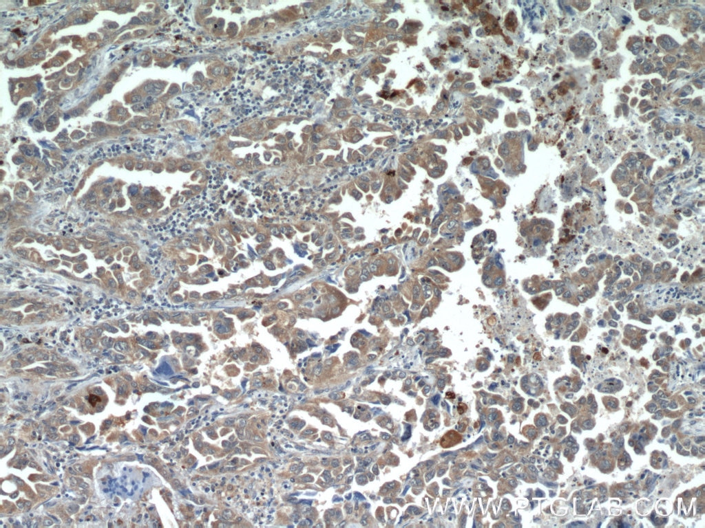 Immunohistochemistry (IHC) staining of human lung cancer tissue using PI3 Kinase p110 Alpha Polyclonal antibody (21890-1-AP)
