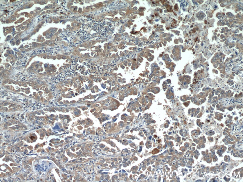 IHC staining of human lung cancer using 21890-1-AP