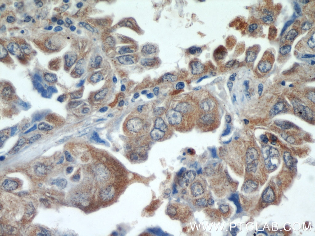 Immunohistochemistry (IHC) staining of human lung cancer tissue using PI3 Kinase p110 Alpha Polyclonal antibody (21890-1-AP)